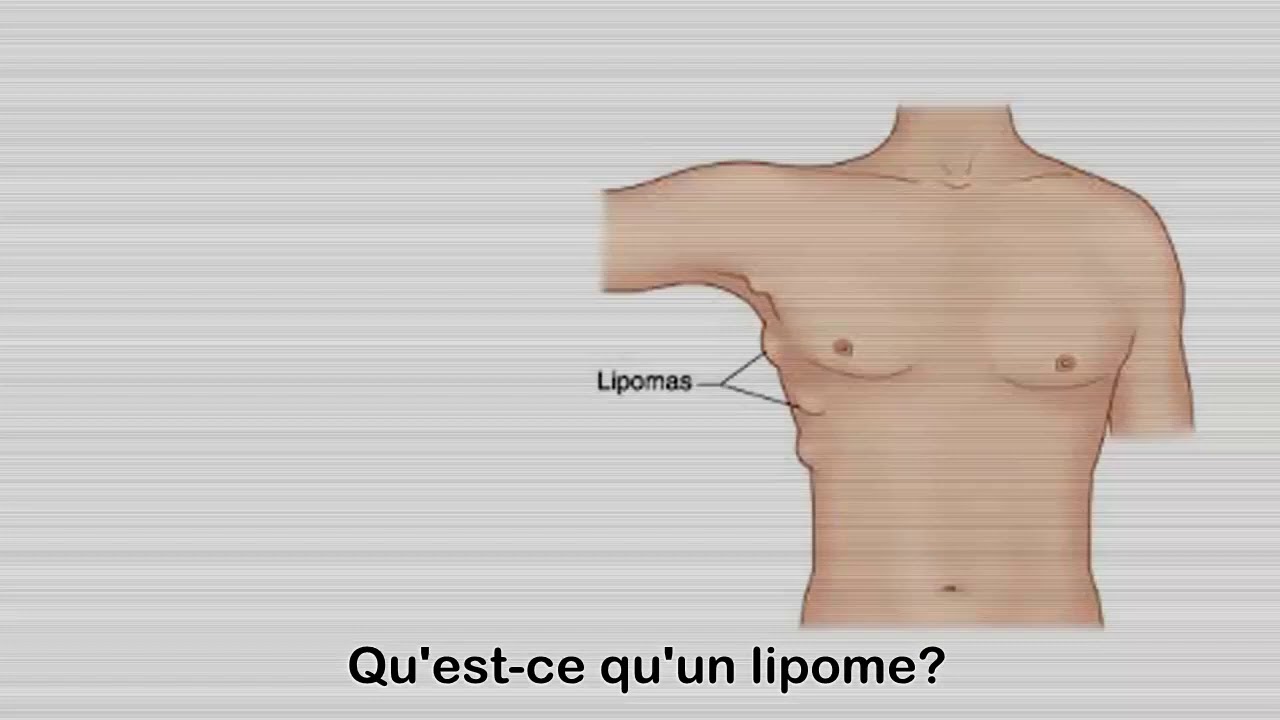 Qu est ce qu'un lipome Symptômes causes | Health Chateau